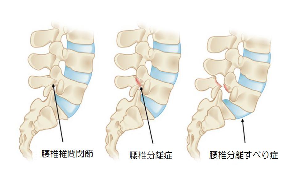 腰椎分離症1
